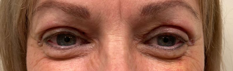 blepharoplastie  après