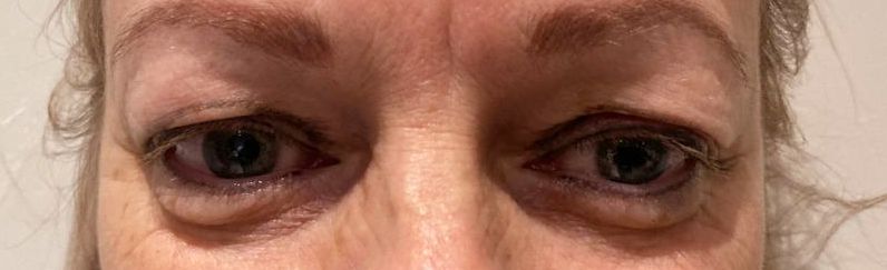 blepharoplastie  avant