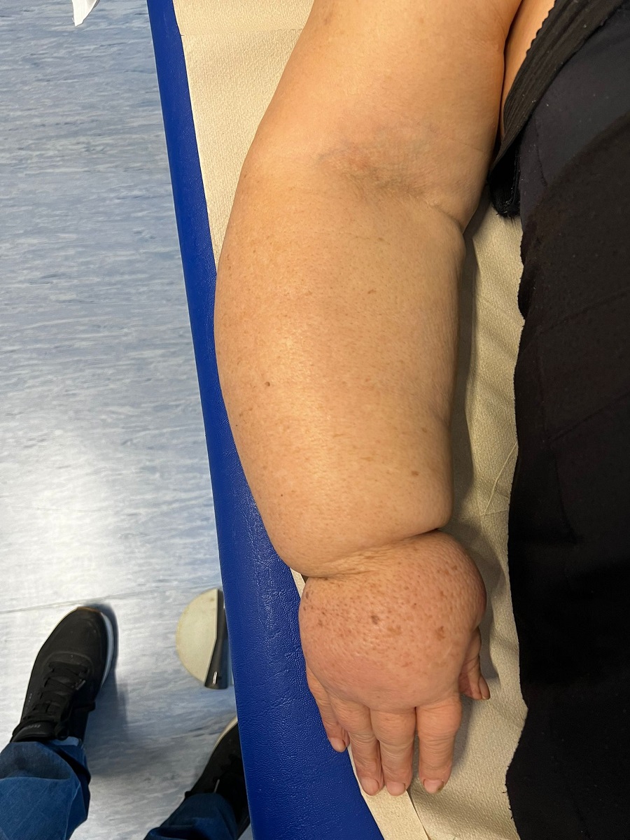 1 Bras début séance